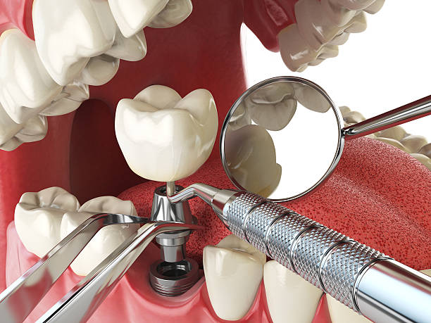 Best Emergency Tooth Extraction in Wormleysburg, PA